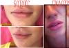 Ботокс в губы, уголки губ, для увеличения и контура